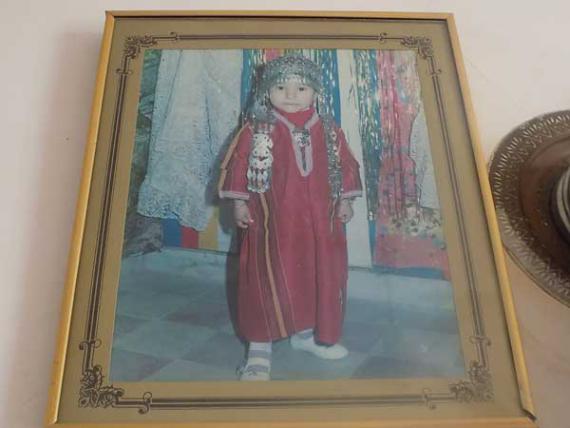 دختری که به مرور همه بدنش استخوان می شود+تصاویر