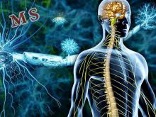 خستگی، افزایش وزن و پوکی استخوان از مهمترین علائم بیماری ام اس