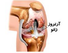 زنان,آرتروز زانو,کم تحرکی,اضافه وزن,کمبود ویتامین D,shabnamha.ir,شبنم همدان,afkl ih,شبنم ها; 